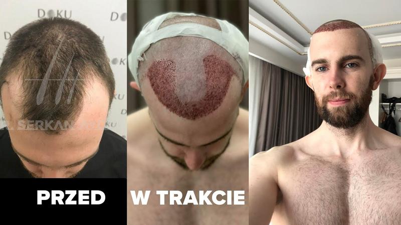 Koszt przeszczepu włosów