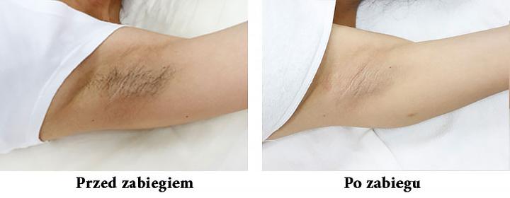 Alternatywy dla depilacji Light Sheer