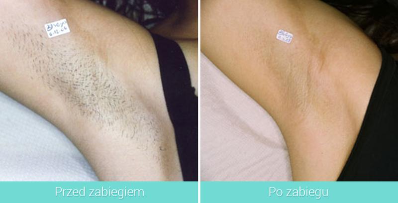 Efektywność depilacji laserowej