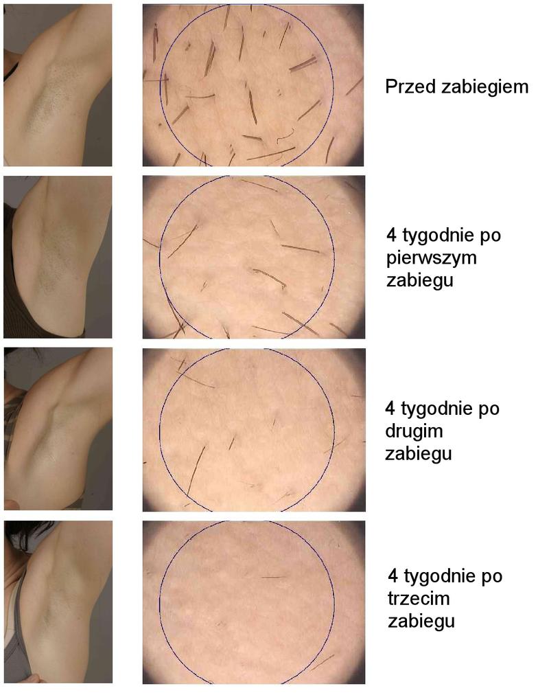 Koszty depilacji laserowej