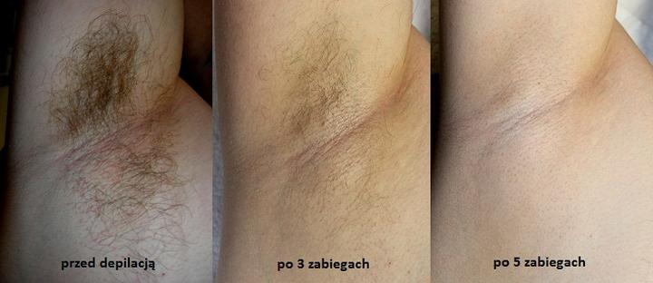 Depilacja laserem Light Sheer - Co mówią opinie o tym zabiegu?