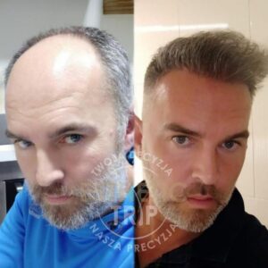 Cena przeszczepu włosów w Turcji – wszystko, co powinieneś wiedzieć przed decyzją